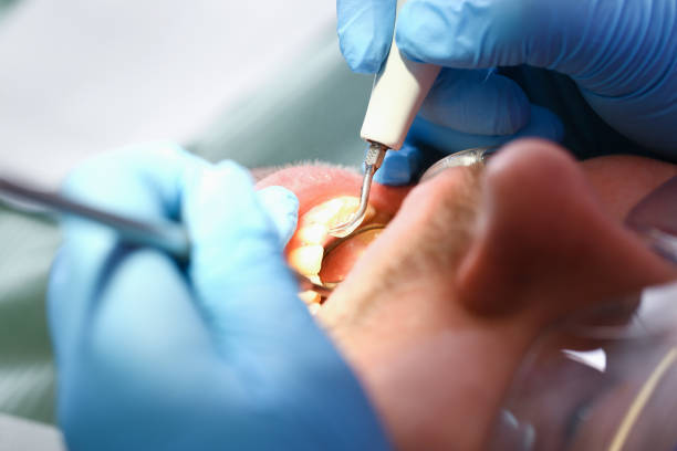Best Emergency Dental Care for Broken or Chipped Teeth in South Duxbury, MA